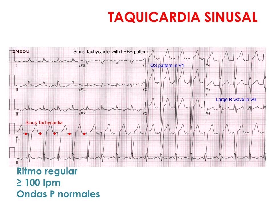 Taquicardias_UAA_Diapositiva_08_1.png