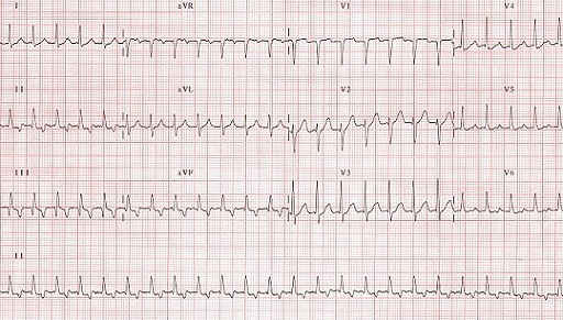 Taquicardias_UAA_Diapositiva_10_1.png