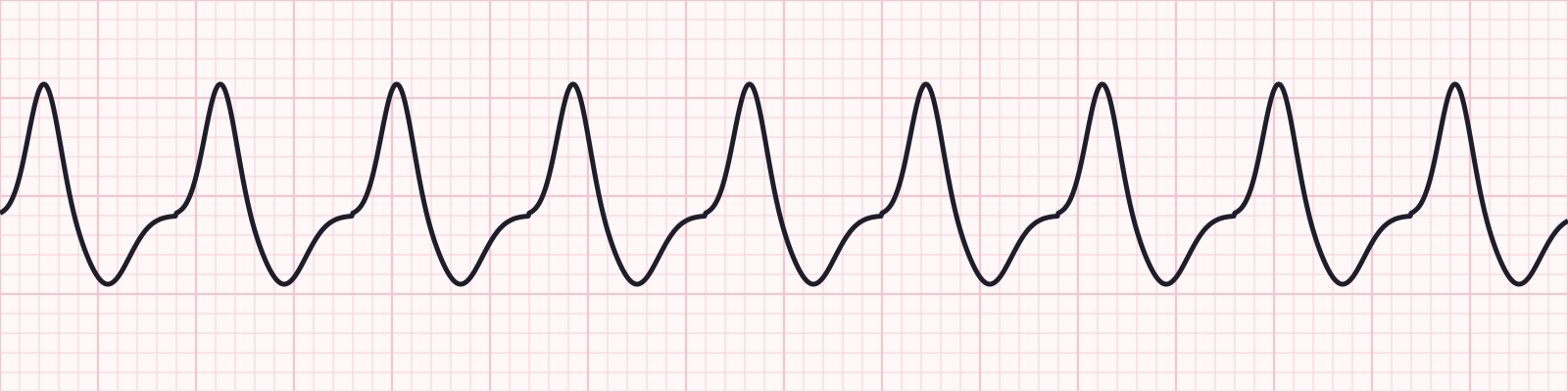 Taquicardias_UAA_Diapositiva_19_1.png