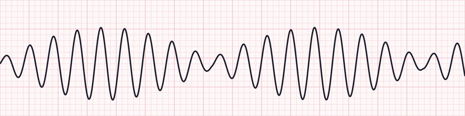 Taquicardias_UAA_Diapositiva_22_4.png