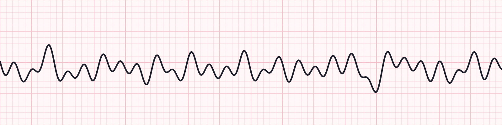 Taquicardias_UAA_Diapositiva_22_7.png