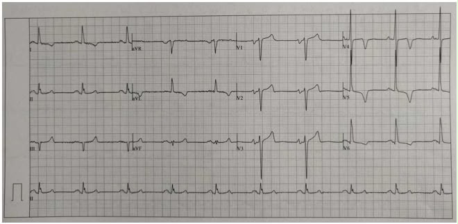 attachments/ECG_practica_01_HVI_sobrecarga_sistolica.jpeg
