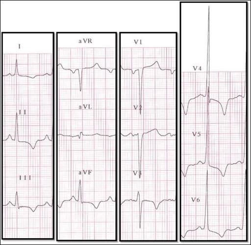 attachments/ECG_practica_02_HVI_sobrecarga_sistolica.jpeg