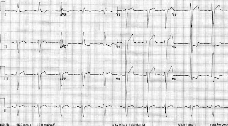 attachments/ECG_practica_03_HVI_mas_BFA.jpeg