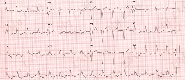 attachments/ECG_practica_04_FA_mas_BRIHH.jpeg