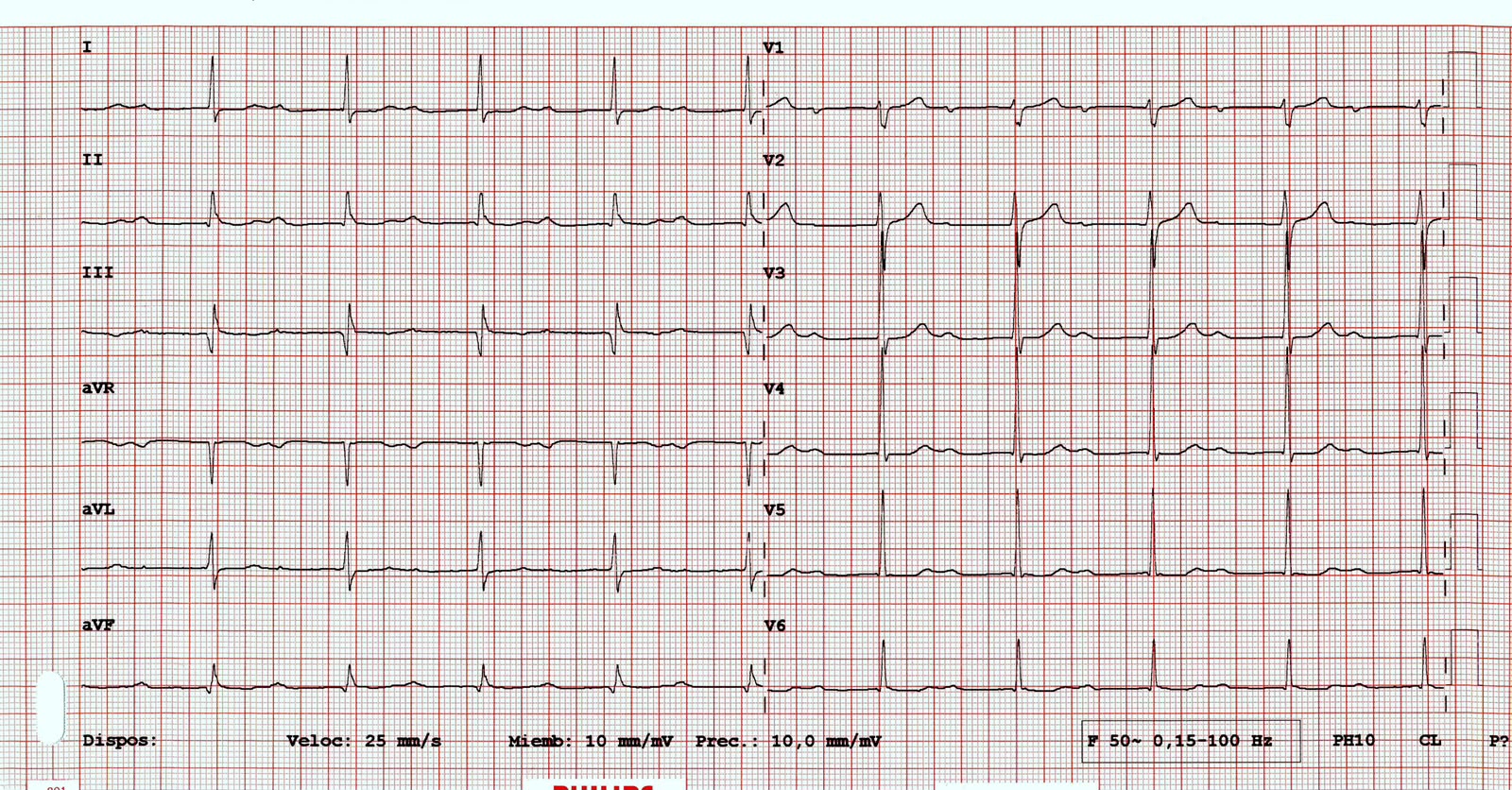 attachments/ECG_practica_06_voltaje_alto_repolarizacion_precoz.jpeg