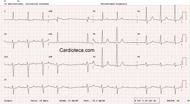 attachments/ECG_practica_08_BFA_transicion_precoz.jpeg