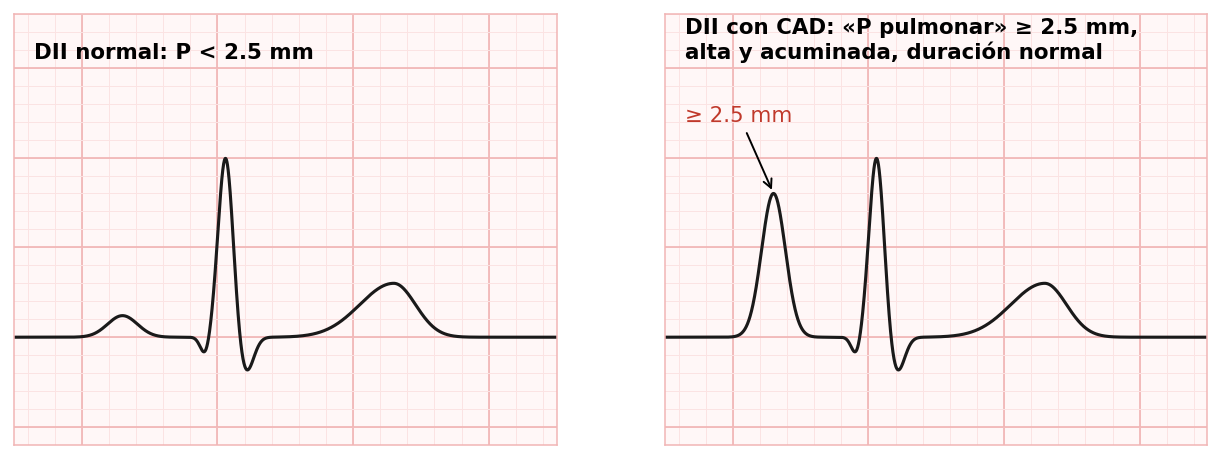 attachments/Slide_crecimiento_CVD_04_CAD_vector_y_P_pulmonar.png