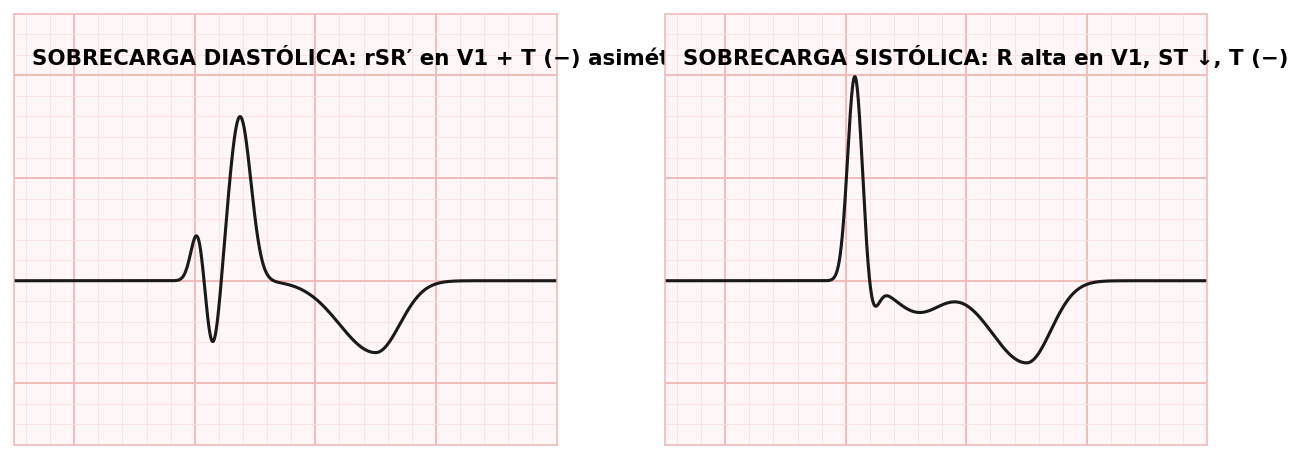 attachments/Slide_crecimiento_CVD_12_sobrecarga_sistolica_VD_ECG_y_Rx.png
