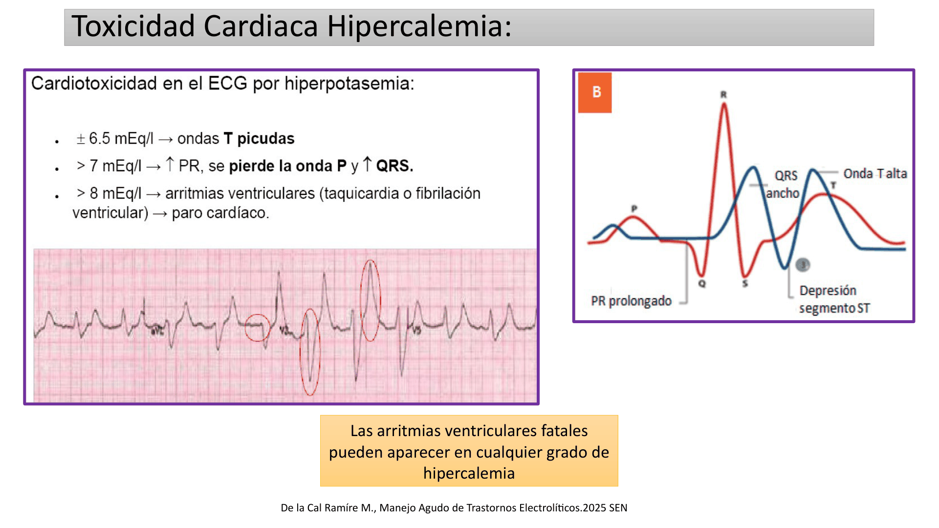 HIPERCALEMIA_D12.png