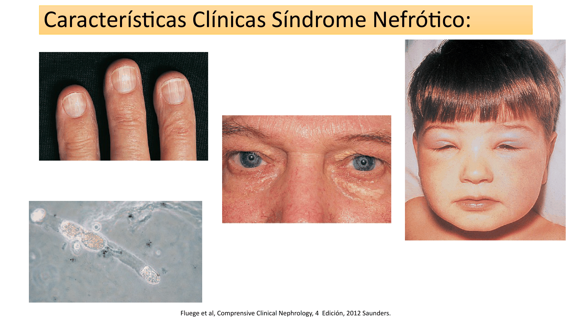 SINDROMENEFROTICOCOMPLETO_D15.png