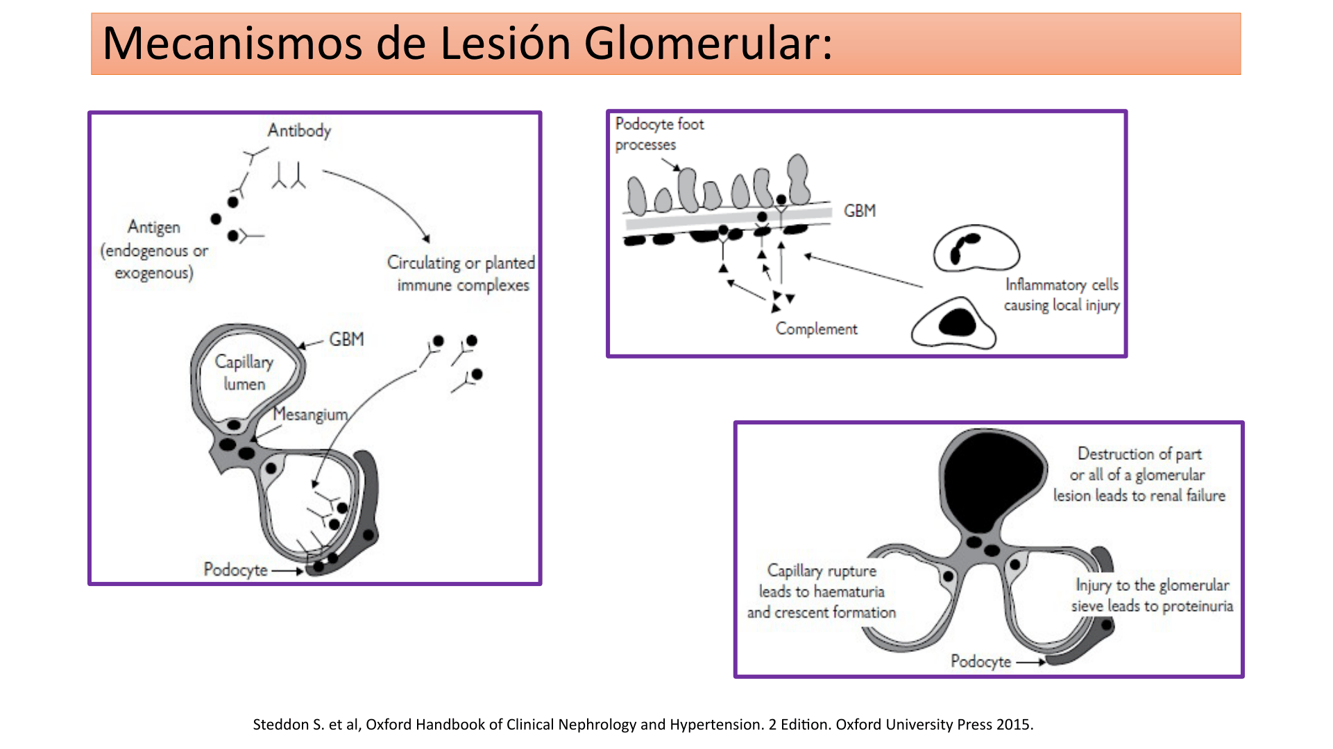 SINDROME_NEFRITICO_D03.png
