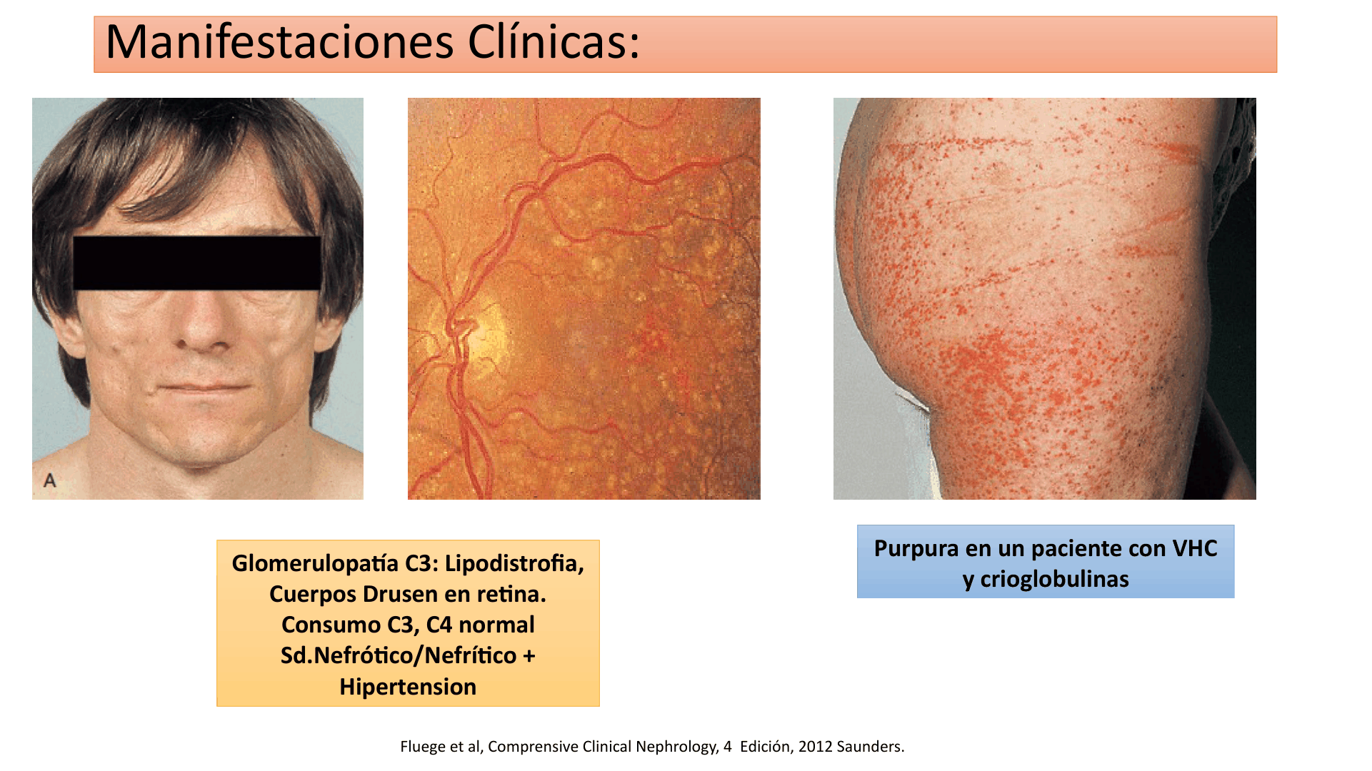 SINDROME_NEFRITICO_D22.png