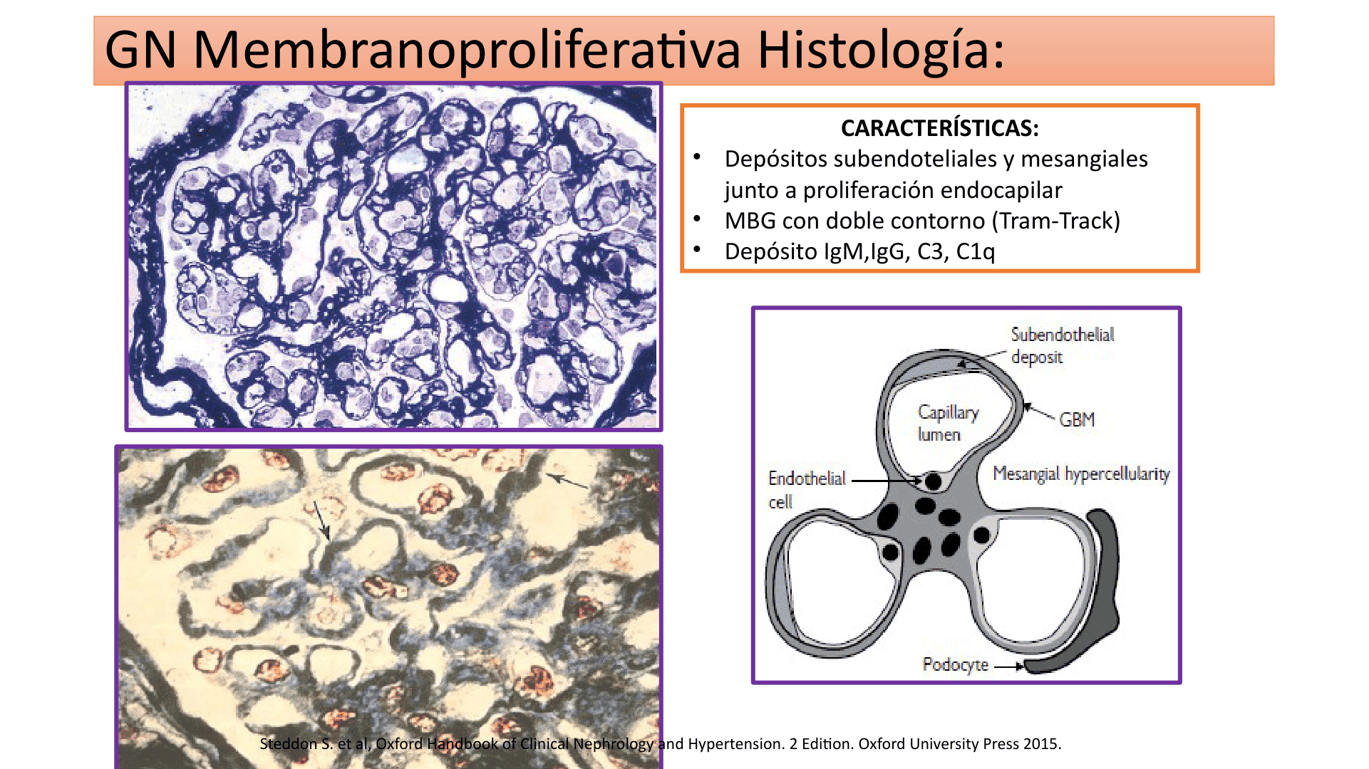 SINDROME_NEFRITICO_D23.png