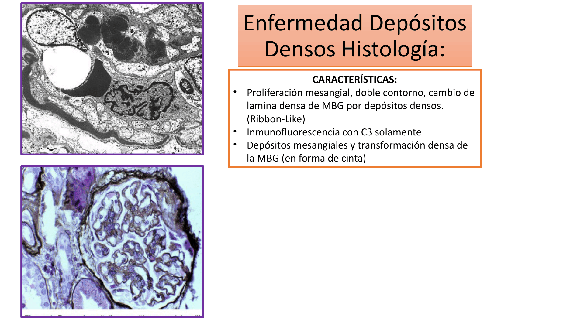 SINDROME_NEFRITICO_D24.png