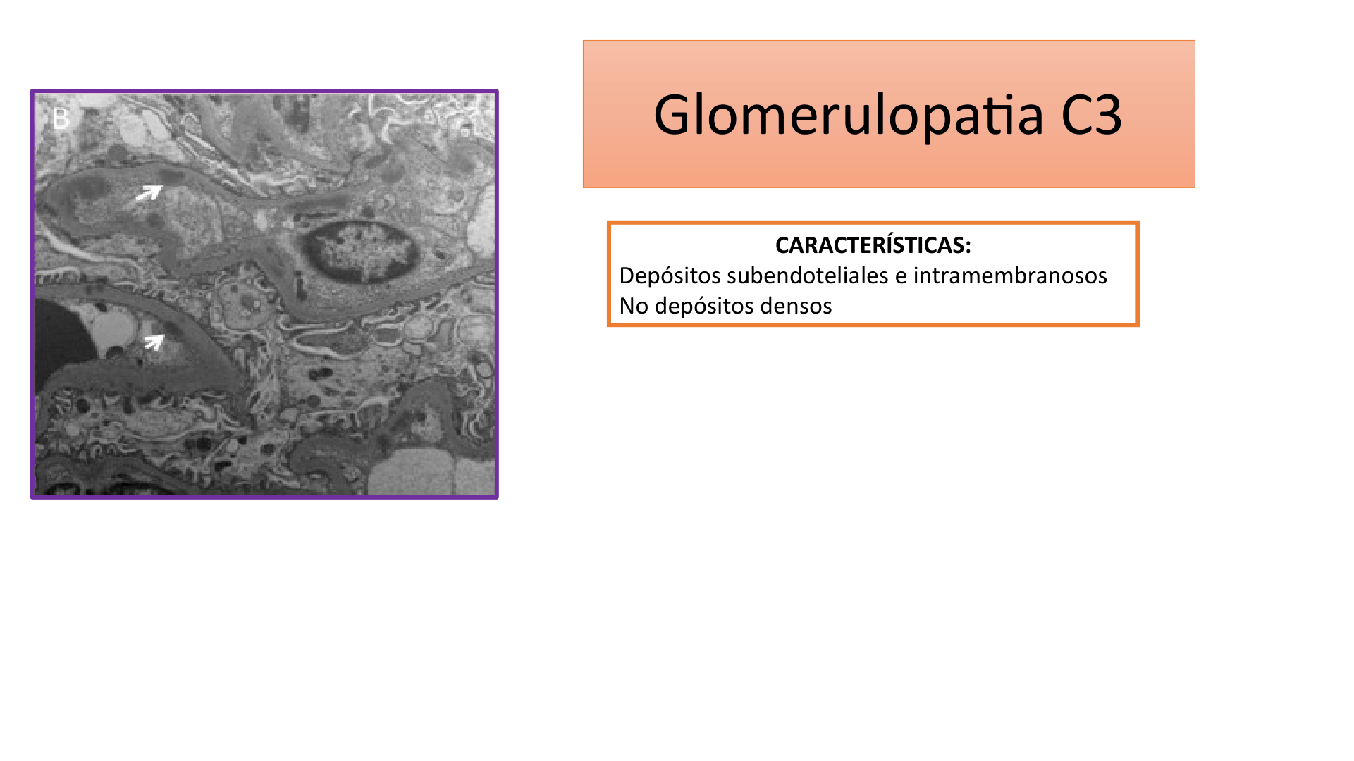 SINDROME_NEFRITICO_D25.png