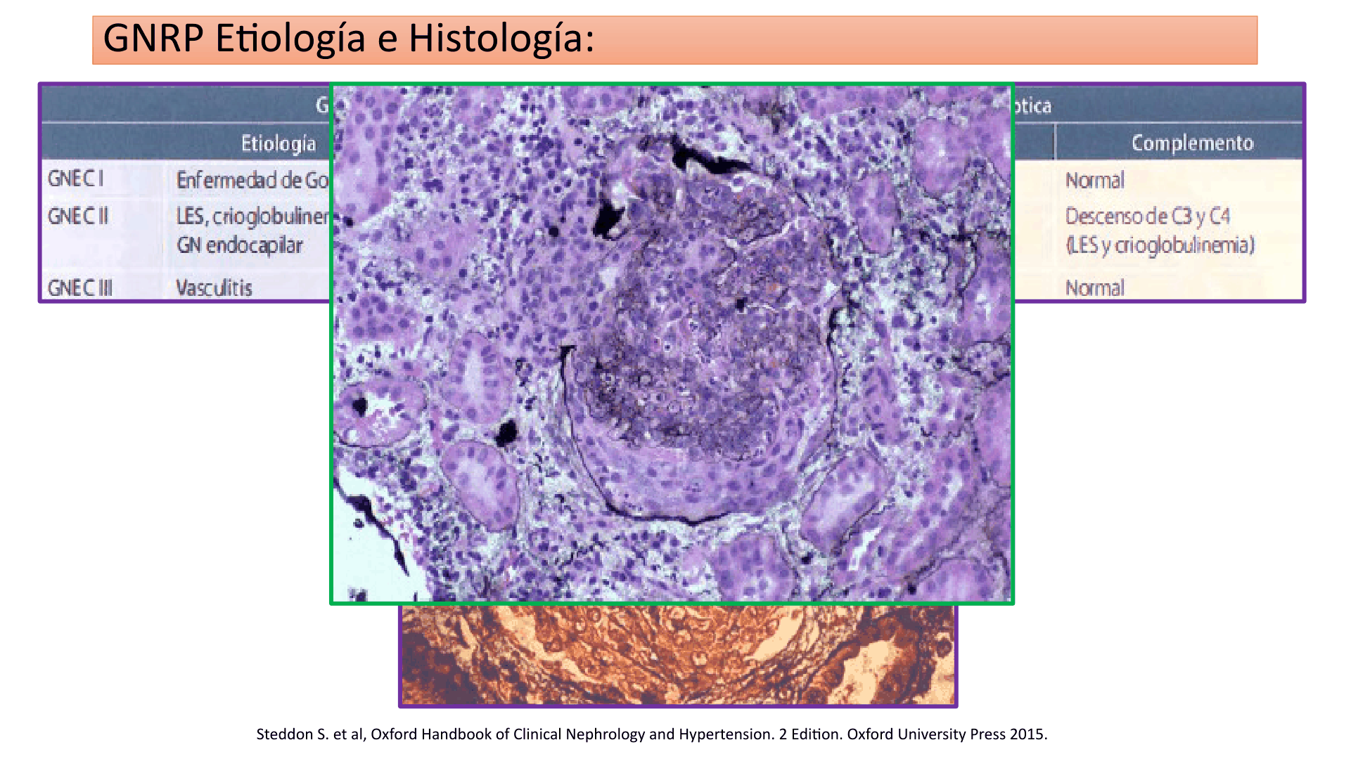 SINDROME_NEFRITICO_D28.png