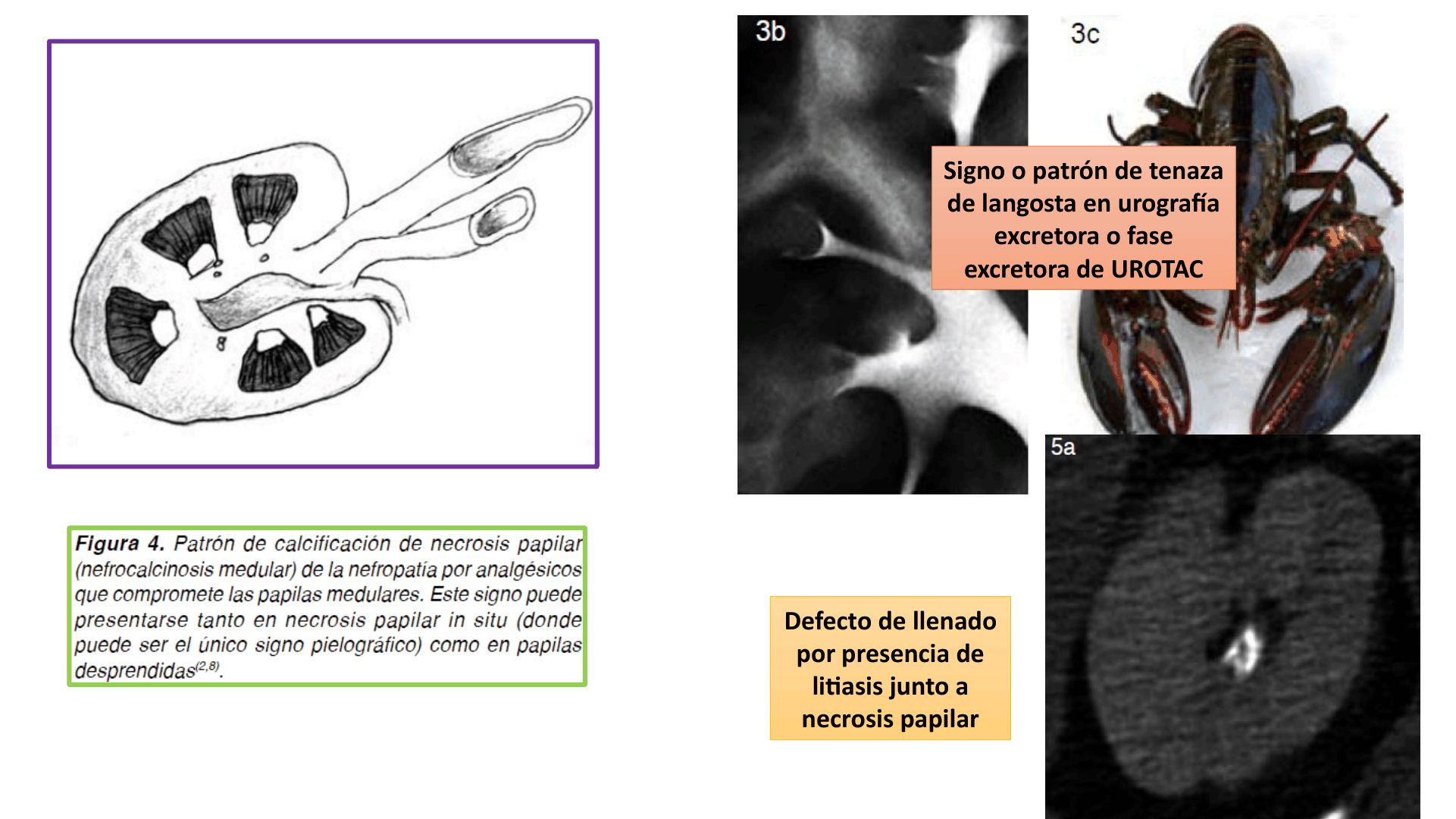 TUBULOINTERSTICIALES_D25.png